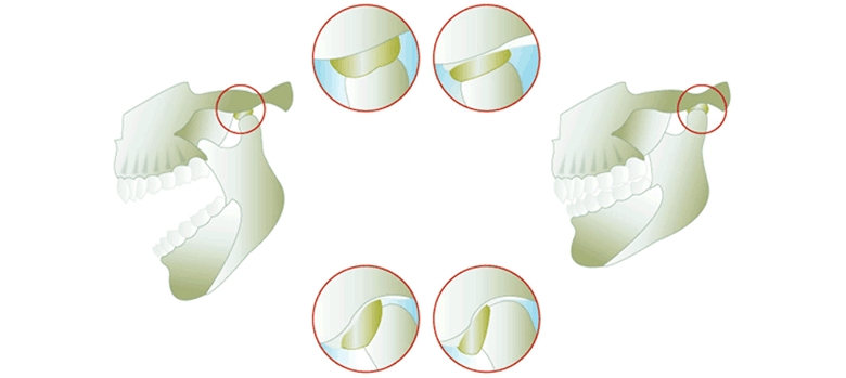 顎関節症・歯ぎしり